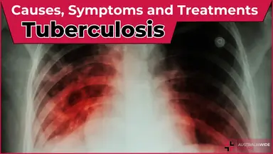 Tuberculosis article header – First Aid Article in Wurtulla